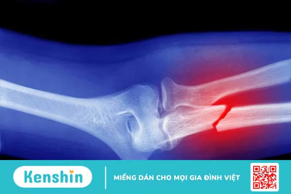 Sơ cấp cứu gãy xương chi từng vị trí kịp thời