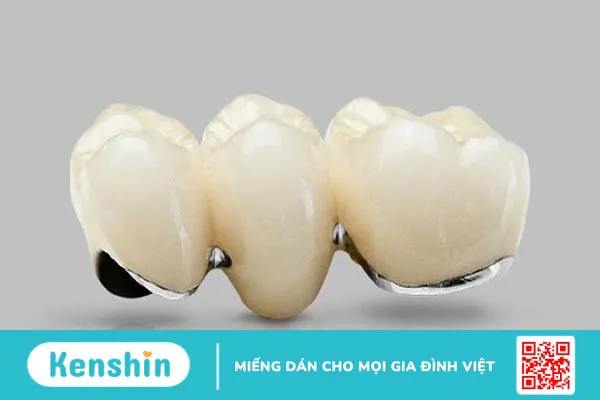 So sánh răng sứ kim loại và răng toàn sứ 1