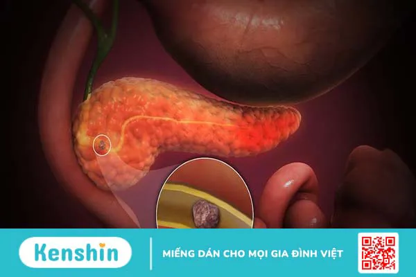 Biểu hiện của sỏi tụy gì? Sỏi tụy có nguy hiểm không? 1