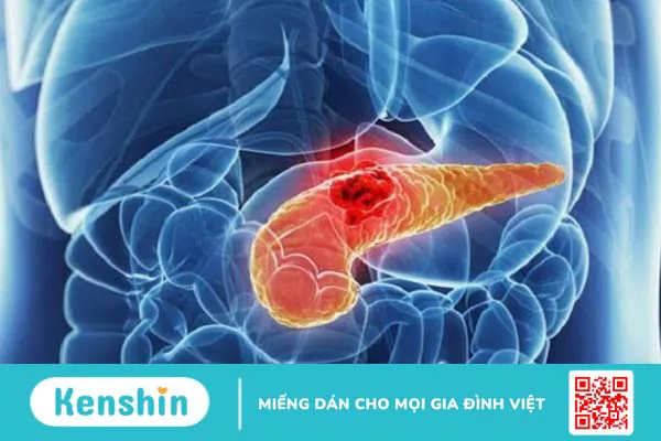 Sỏi tụy là bệnh gì? Sỏi tụy có nguy hiểm không?