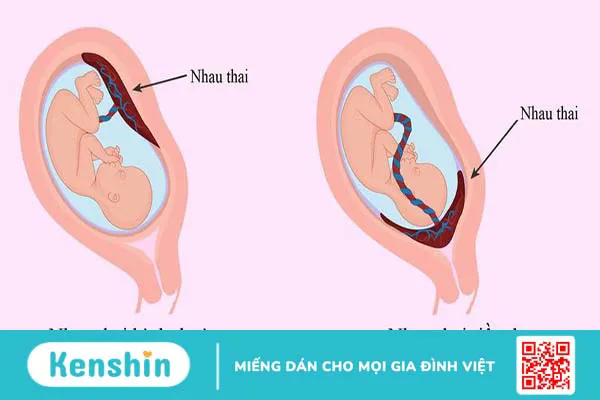 Sót nhau sau sinh: Nguyên nhân, triệu chứng, điều trị và cách phòng ngừa 1