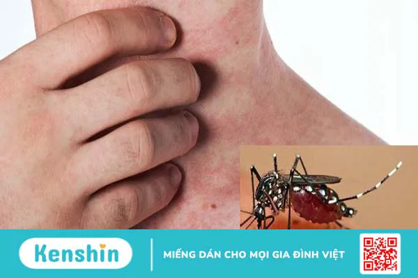 Sốt xuất huyết tắm lá gì? Sốt xuất huyết có tắm được không?