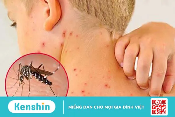 Bệnh sốt xuất huyết ủ bệnh mấy ngày 3