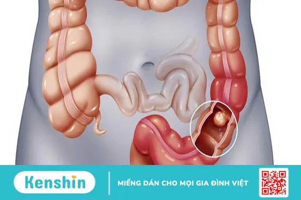 Sự khác nhau giữa bệnh trĩ và ung thư đại trực tràng