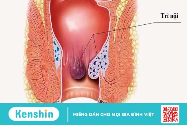 Sự khác nhau giữa bệnh trĩ và ung thư đại trực tràng 2