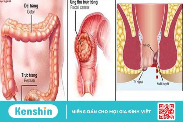 Sự khác nhau giữa bệnh trĩ và ung thư đại trực tràng 3