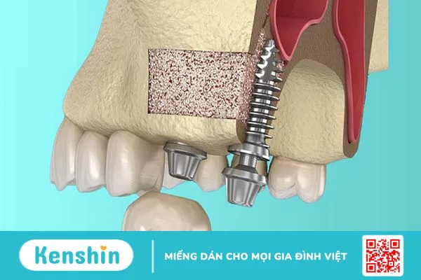 Sự khác nhau giữa nâng xoang kín và nâng xoang hở 2