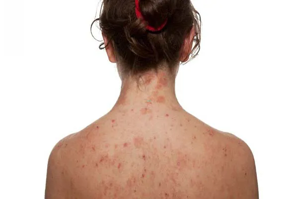 Sữa tắm giảm mụn lưng Neo Acnes tinh chất tràm trà có hiệu quả không?