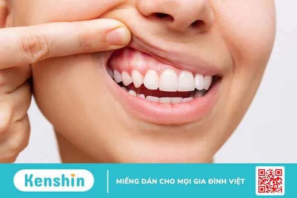 Sưng nướu răng hàm trên là dấu hiệu của bệnh lý gì? 1