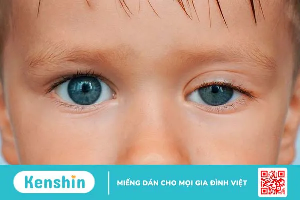 Sụp mí bẩm sinh: Nguyên nhân, biểu hiện nhận biết các cách điều trị bệnh hiệu quả  1