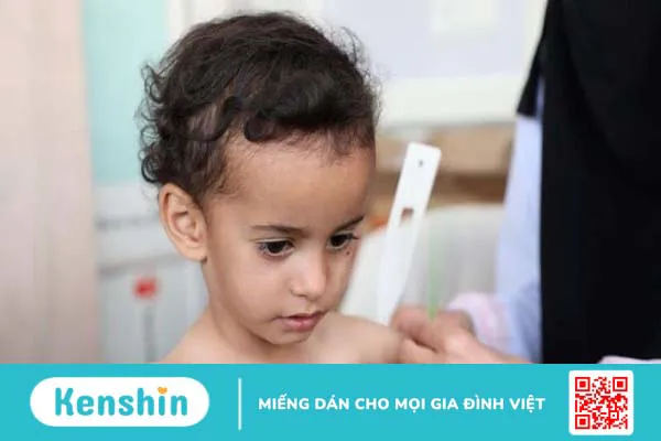 Suy dinh dưỡng trẻ em: Nguyên nhân, biểu hiện và các chăm sóc