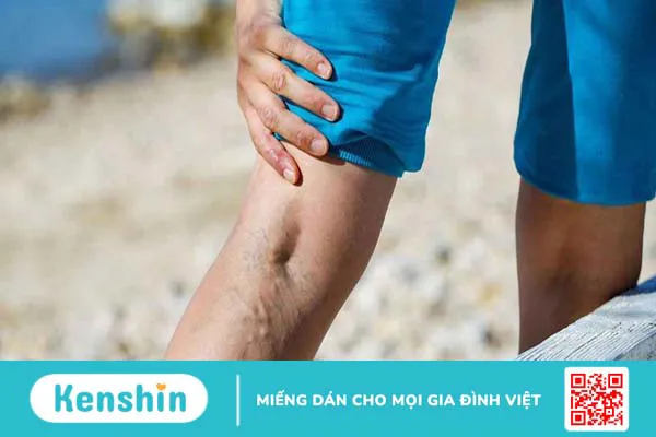 Suy giãn tĩnh mạch ven là gì? Cách phòng ngừa bệnh