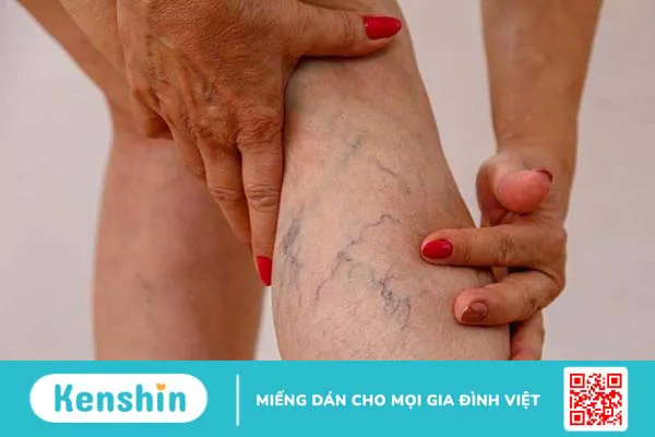 Suy giãn tĩnh mạch ven là gì? Cách phòng ngừa bệnh 1