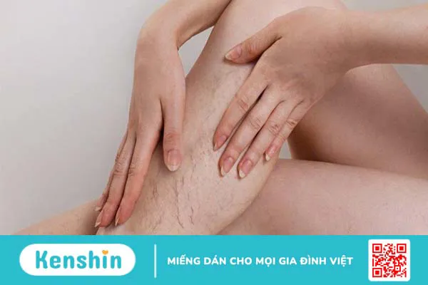 Suy giãn tĩnh mạch ven là gì? Cách phòng ngừa bệnh 3