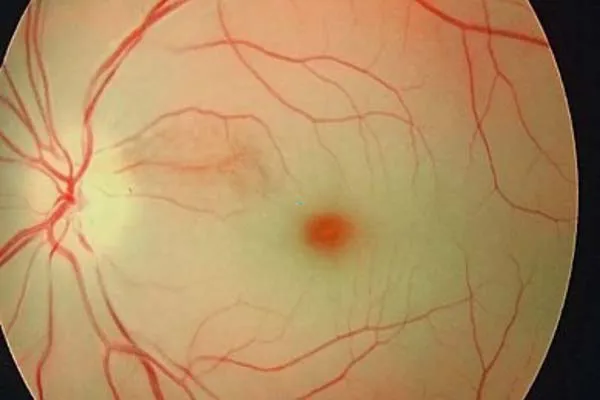 Tắc động mạch mắt: Nguyên nhân, dấu hiệu và cách điều trị