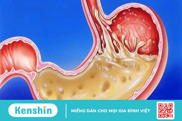 Tác dụng của nhóm PPI trong điều trị bệnh 1