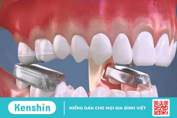 Tác dụng của việc nâng khớp cắn trong niềng răng