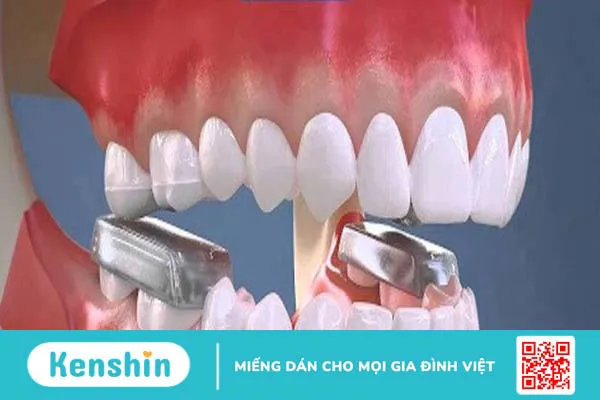 Tác dụng của việc nâng khớp cắn trong niềng răng