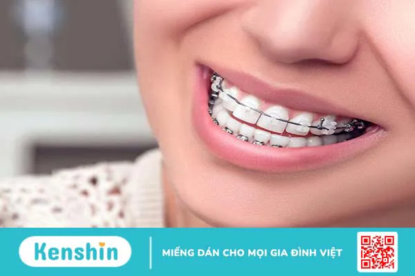 Tác dụng của việc nâng khớp cắn trong niềng răng