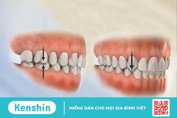 Tác dụng của việc nâng khớp cắn trong niềng răng