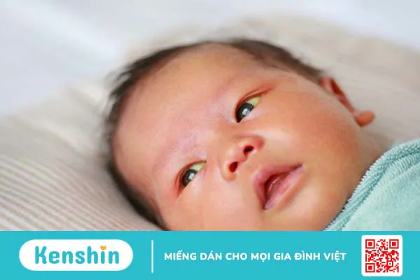 Tắc lệ đạo bẩm sinh: Nguyên nhân, triệu chứng, cách chẩn đoán và điều trị bệnh 2