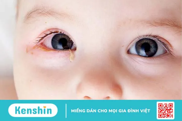 Tắc lệ đạo bẩm sinh: Nguyên nhân, triệu chứng, cách chẩn đoán và điều trị bệnh 4