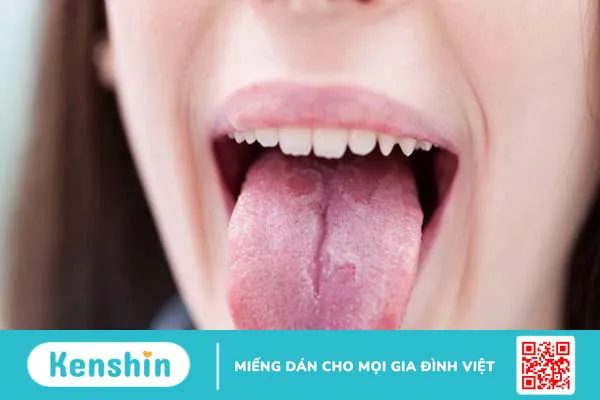 Tại sao lưỡi có đốm đỏ? Một số bệnh lý liên quan đến lưỡi thường gặp