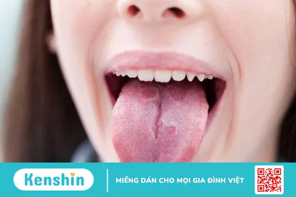 Tại sao lưỡi có đốm đỏ? Một số bệnh lý liên quan đến lưỡi thường gặp