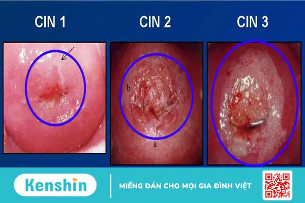 Tân sinh là gì? Tìm hiểu về bệnh lý tân sinh biểu mô cổ tử cung 2