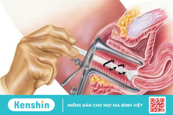 Tân sinh là gì? Tìm hiểu về bệnh lý tân sinh biểu mô cổ tử cung 4