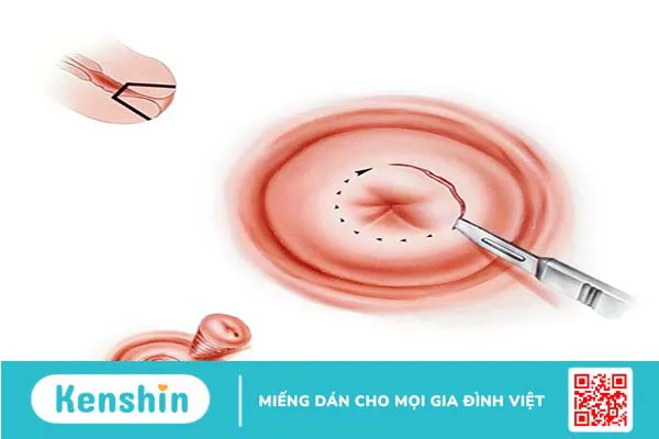 Tân sinh là gì? Tìm hiểu về bệnh lý tân sinh biểu mô cổ tử cung 5