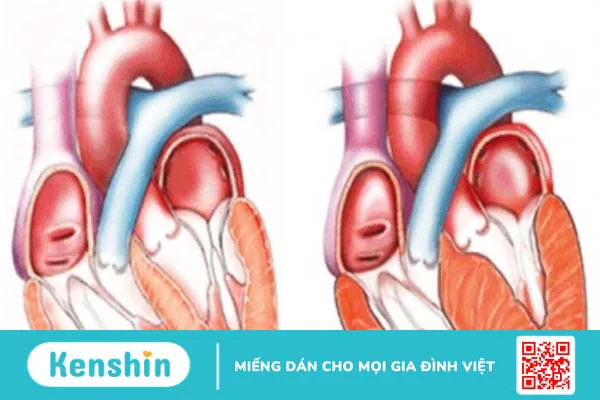 Tăng gánh thất trái là gì? Nguyên nhân và phương pháp điều trị hiệu quả