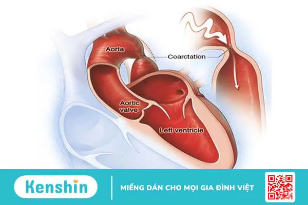 Tăng gánh thất trái là gì? Nguyên nhân và phương pháp điều trị hiệu quả