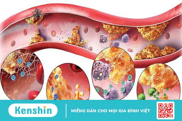 Tăng lipid máu là gì? Nguyên nhân gây tăng lipid máu ở người bệnh 1