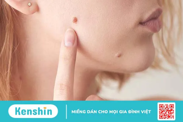 Tẩy nốt ruồi có được uống cà phê không? 3