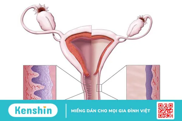 Teo âm đạo và những điều cần biết 1