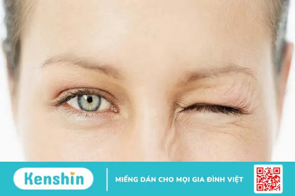 Teo nhãn cầu bẩm sinh: Nguyên nhân, triệu chứng và phương pháp điều trị