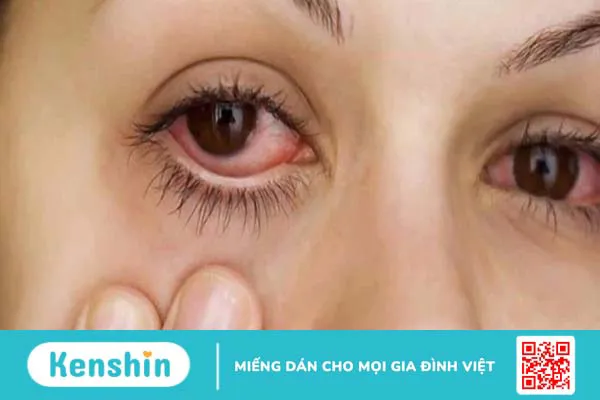 Teo nhãn cầu bẩm sinh: Nguyên nhân, triệu chứng và phương pháp điều trị