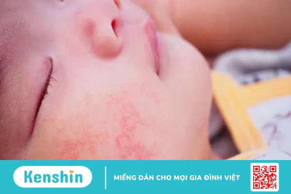 Thắc mắc: Trẻ sơ sinh bị viêm da cơ địa mẹ kiêng ăn gì?