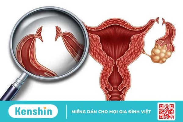 Thắt ống dẫn trứng có làm giảm ham muốn tình dục không?