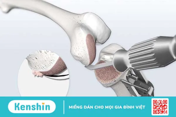 Thay khớp gối gióng trục động học là gì? Những điều cần biết