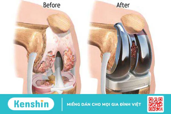 Thay khớp gối ở bệnh viện nào tốt nhất?