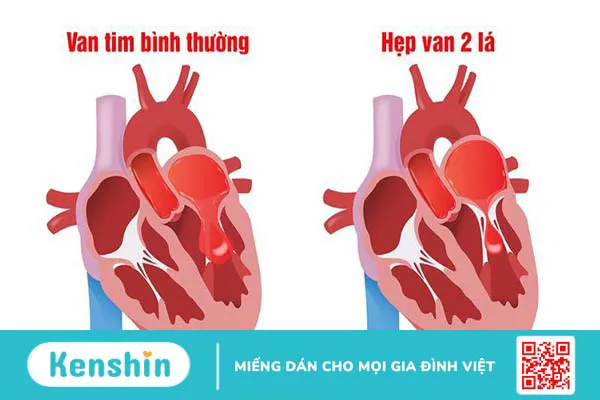 Thay van hai lá ở bệnh viện nào tốt nhất? 2