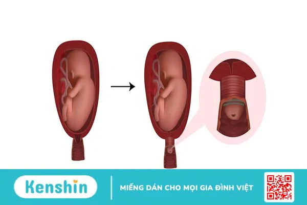 Thiếu máu cổ tử cung là gì? Nguyên nhân và cách điều trị 4