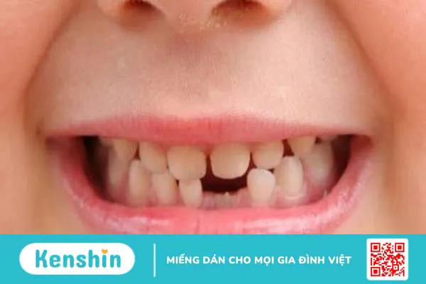 Thiếu răng bẩm sinh có nguy hiểm không? Cách xử lý tình trạng này thế nào?