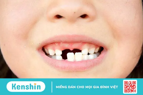 Thiếu răng bẩm sinh có nguy hiểm không? Cách xử lý tình trạng này thế nào? 1