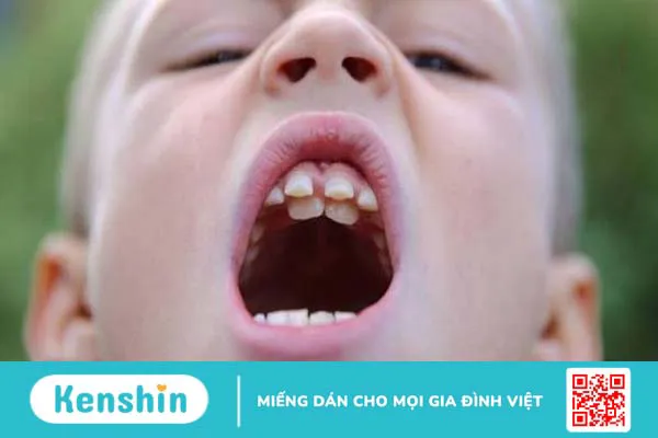 Thiếu răng bẩm sinh có nguy hiểm không? Cách xử lý tình trạng này thế nào? 2