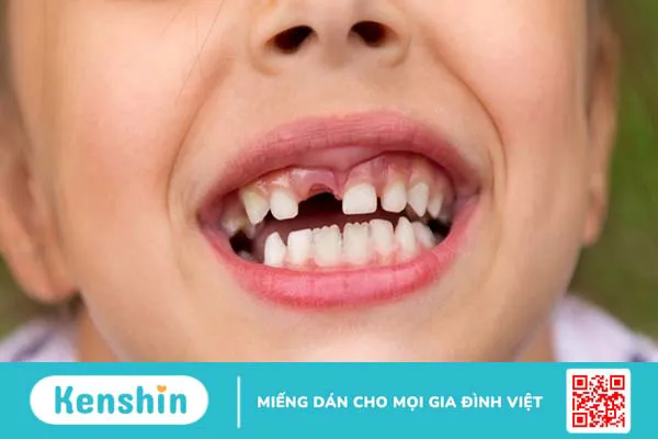 Thiếu răng bẩm sinh có nguy hiểm không? Cách xử lý tình trạng này thế nào? 3