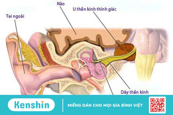 Thính giác là gì? Cấu tạo và cơ chế hoạt động của hệ thính giác 3