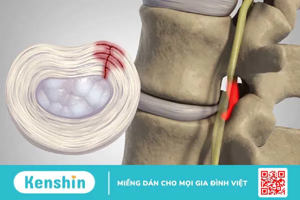 Thoát vị đĩa đệm nội xốp là bệnh gì? Cách phòng tránh và điều trị